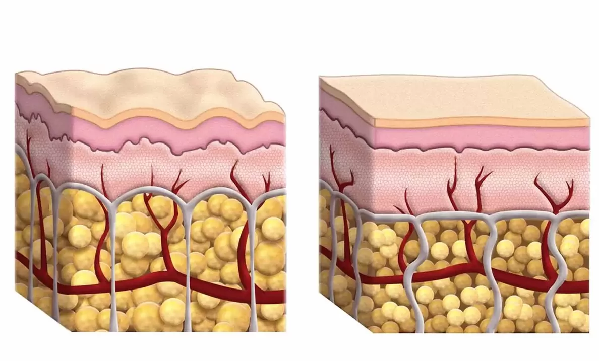 Adipose cells during the use of Guru Keto